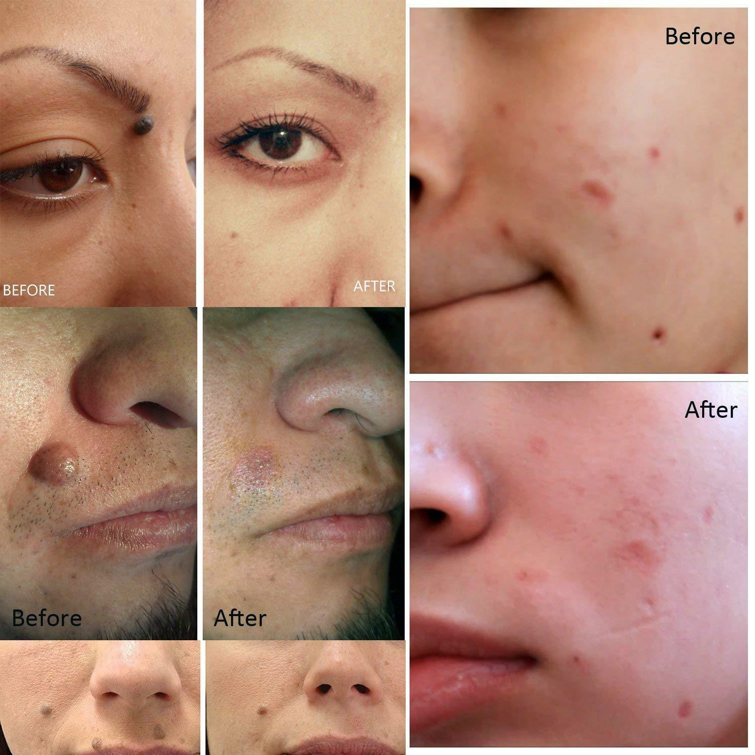 Skin tag Remover Pen, Mole and Wart Removal from home