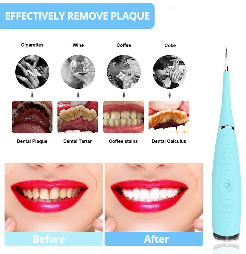 Dental Calculus Remover