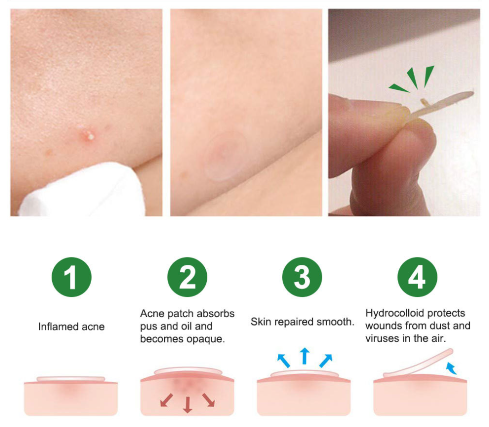 pimple-patches
