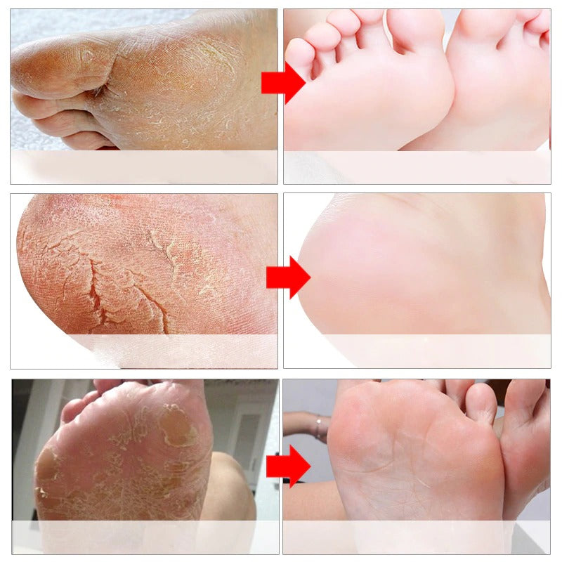 Original Baby Foot Peel Exfoliating Mask